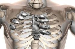 Ra đời xương in 3D tùy chỉnh