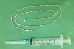 Sợi dây chuyền dài gần 40 cm trong dạ dày bé 2 tuổi