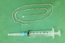 Nội soi dạ dày dây chuyền bạc dài gần 40 cm ở trẻ hơn 2 tuổi