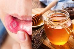 Những giải pháp tự nhiên giúp điều trị nhiệt miệng cực hiệu quả