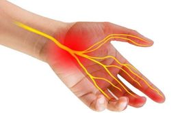 Chữa trị hội chứng ống cổ tay thế nào?