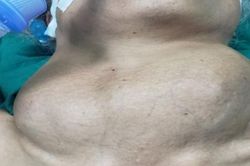 Người đàn ông mang khối u lớn suốt 20 năm trên cổ