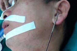 Cấp cứu một người ở xã Sơn Lôi, tỉnh Vĩnh Phúc bị thanh sắt găm giữa cổ