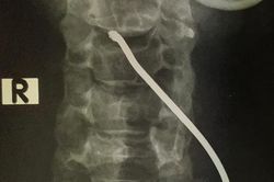 Xe tải nổ lốp, người đàn ông sửa xe trước cửa nhà bị thanh sắt bắn vào cổ