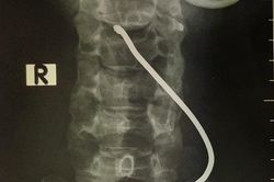 Nổ lốp xe tải, người đàn ông bị thanh sắt bắn vào cổ