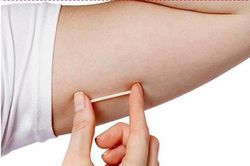 Miễn phí khám cấy que tránh thai: Chỉ làm 1 lần - hiệu quả 3 năm