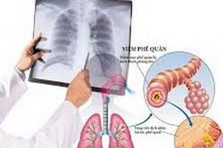Phòng ngừa viêm phế quản mạn tính ở người cao tuổi