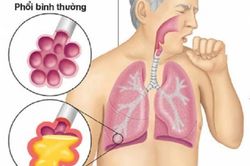 Nấm phổi do Aspergillus: Bệnh nguy hiểm nhưng ít người biết