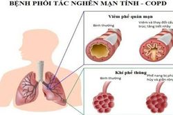 Tiếp tục Phát huy hiệu quả của mạng lưới quản lý, điều trị bệnh phổi tắc nghẽn mãn tính