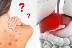 Những dấu hiệu cảnh báo bệnh gan mà bạn không thể bỏ qua, nhất là số 1