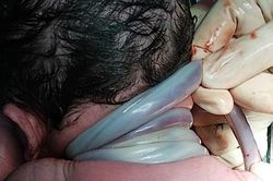 Bé trai bị dây rốn quấn cổ 4 vòng