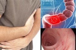 Viêm loét đại trực tràng chảy máu: Phát hiện sớm, tránh biến chứng đáng tiếc