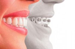 Phương pháp điều trị răng hô ở người lớn