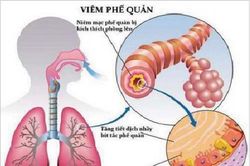 Mật ong - thuốc tốt trị viêm phế quản