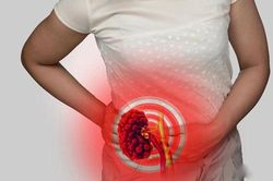 Dấu hiệu và triệu chứng cảnh báo sỏi thận mà rất nhiều người mắc phải