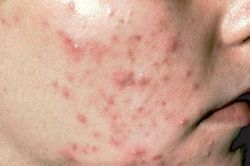 Mách bạn về nguyên nhân khiến da bạn mụn mãi không hết