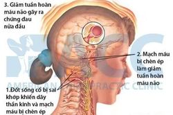 Chứng đau nửa đầu và cách xử trí