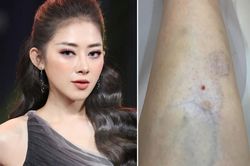 Hotgirl Mai Sương bị teo cơ do xóa thâm chân, suy sụp khi biết điều trị 10 năm liền cũng chỉ phục hồi 50%