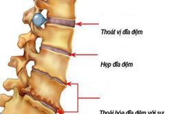 Nhận biết một số bệnh cột sống thường gặp