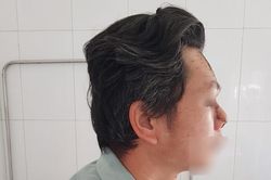 Người đàn ông Hà Nội phải cắt cụt mũi vì ung thư