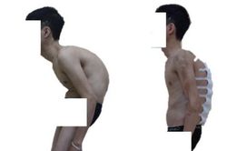 Nắn chỉnh biến dạng cột sống thành công cho bệnh nhân 'siêu gù'