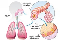 Phòng ngừa bệnh phổi tắc nghẽn mạn tính
