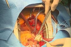 Người phụ nữ phải mổ tim lần 2 vì tự dừng uống thuốc