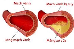 Thuốc điều trị suy mạch vành