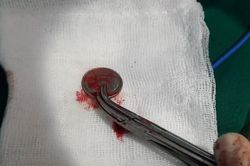 Cứu sống bệnh nhân bị hóc đồng xu