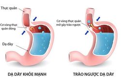 Dùng thuốc trị ho khan hiệu quả