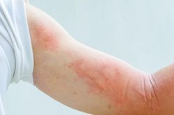 Thời tiết chuyển mùa, bệnh mề đay dễ xuất hiện