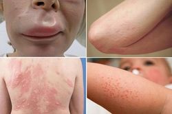 Lưu ý khi bị dị ứng thời tiết