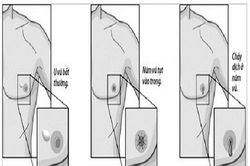 Đàn ông cũng phải cảnh giác với ung thư vú