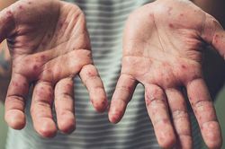 5 căn bệnh nguy hiểm thường dễ mắc vào mùa hè và cách chữa trị