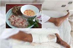 Người đàn ông ăn gỏi cá rô suýt phải cưa chân