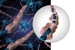 Bệnh nhân COVID-19 nặng có thể mắc hội chứng Guillain-Barre