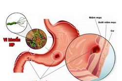 Teo niêm mạc dạ dày có nguy hiểm?