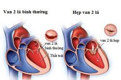Nhận biết và phòng ngừa hẹp van hai lá
