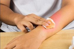 Hồng Ngọc bị bỏng nặng mặt, ngực: Làm thế nào chữa nhanh, xóa sẹo hiệu quả?