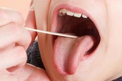 Viêm amidan gây biến chứng gì?