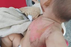 Bé 2 tuổi bỏng nặng do nghịch nước sôi nấu mì tôm
