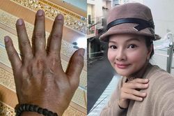 Diễn viên Kiều Trinh mặt sưng, tay sạm đen, khó thở vì ngộ độc hải sản