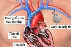 Block nhĩ thất (Block tim)
