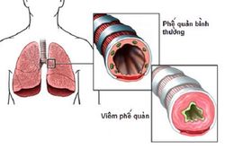 Mật ong trong bài thuốc trị viêm phế quản