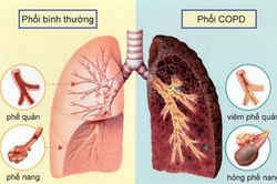 Phương thuốc hay phòng trị bệnh hô hấp mạn tính