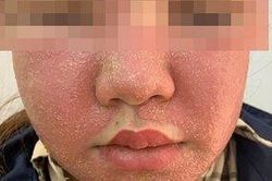 Mua mặt nạ làm trắng da trên mạng sử dụng, cô gái bị sưng phù mặt, nổi mụn mủ chi chít