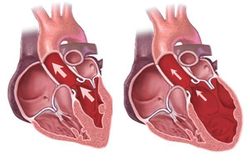 Ai dễ mắc bệnh thấp tim?