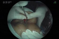 Tai nạn hy hữu do nuốt phải tăm xỉa răng trong khi ngủ