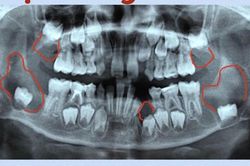 Bệnh viện Đa khoa tỉnh Khánh Hòa: Điều trị thành công cho bệnh nhi bị nhiều tổn thương dạng nang xương hàm