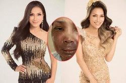 Xúc động với tấm lòng của Hồng Ngọc khi lần đầu đăng tải gương mặt bị bỏng nghiêm trọng